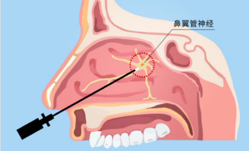 使用外科手術治療的優缺點比較優點② 通過一次操作即可大幅度緩解