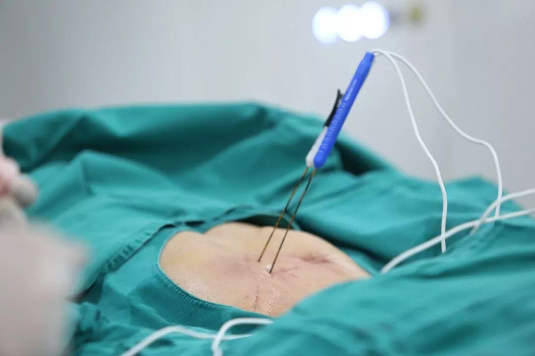 长沙肿瘤医院选择广州复大肿瘤医院纳米刀治胰腺癌有了巨大突破