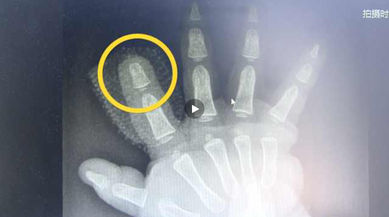 家长注意！兔子急了真会咬人 1岁男童被兔子咬断手指