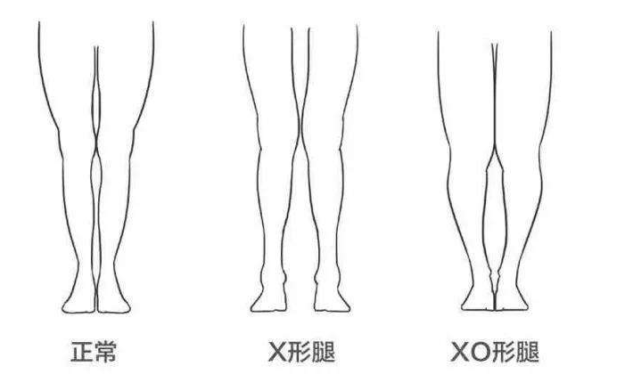 怎样区分o型腿和x型腿?武汉中阳中医院四维矫形矫正各种腿型异常