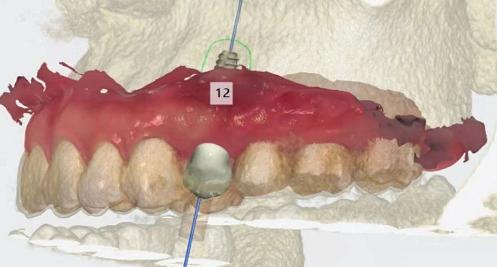 如履薄冰，泰康拜博口腔种植大师周磊教授的严谨与创新