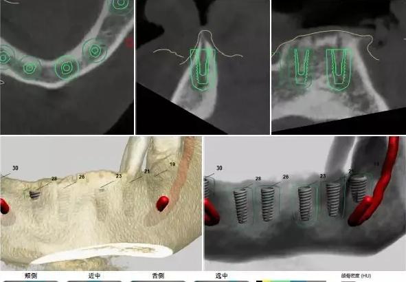 如履薄冰，泰康拜博口腔种植大师周磊教授的严谨与创新