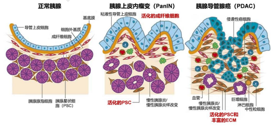 聚焦 癌中之王 这项研究将为胰腺癌可视化诊疗提供新策略 凤凰网