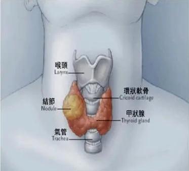 成都民生耳鼻喉成功为患者实施甲状腺癌手术53岁阿姨绝处逢生