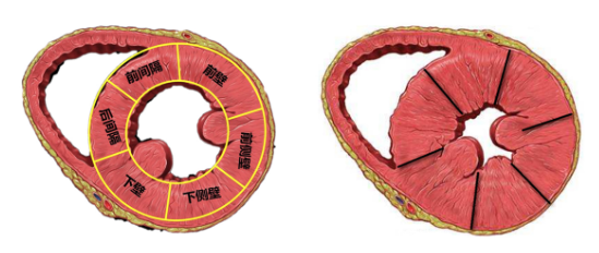 左位正常心脏,右为肥厚心脏