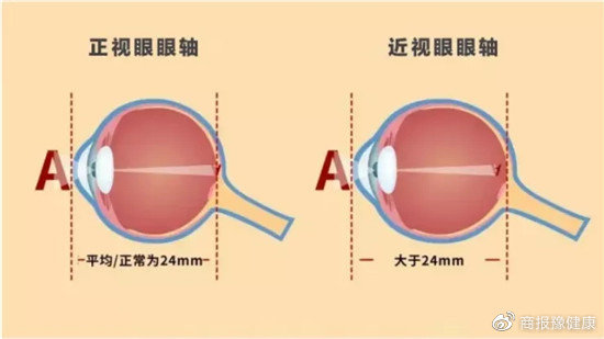 高度近视眼底图片 A8502C25FA6D1201AB79096EB5031C1775D1FE2C_size27_w550_h309.jpg