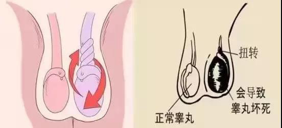 睾丸扭转示意图。