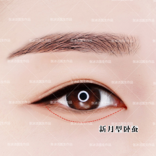 新月型卧蚕图示:新月型卧蚕(眼台)千人千面,万人万眼.