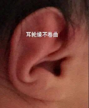 环缩耳:耳轮缘覆盖对耳轮,或粘连,耳舟消失