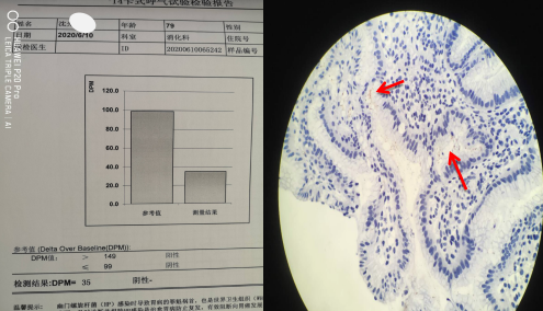 幽门螺杆菌检查报告图片