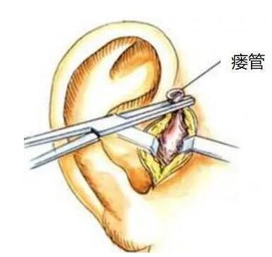 那么,耳仓到底是什么呢?这个小眼在医学上称之为耳前瘘管