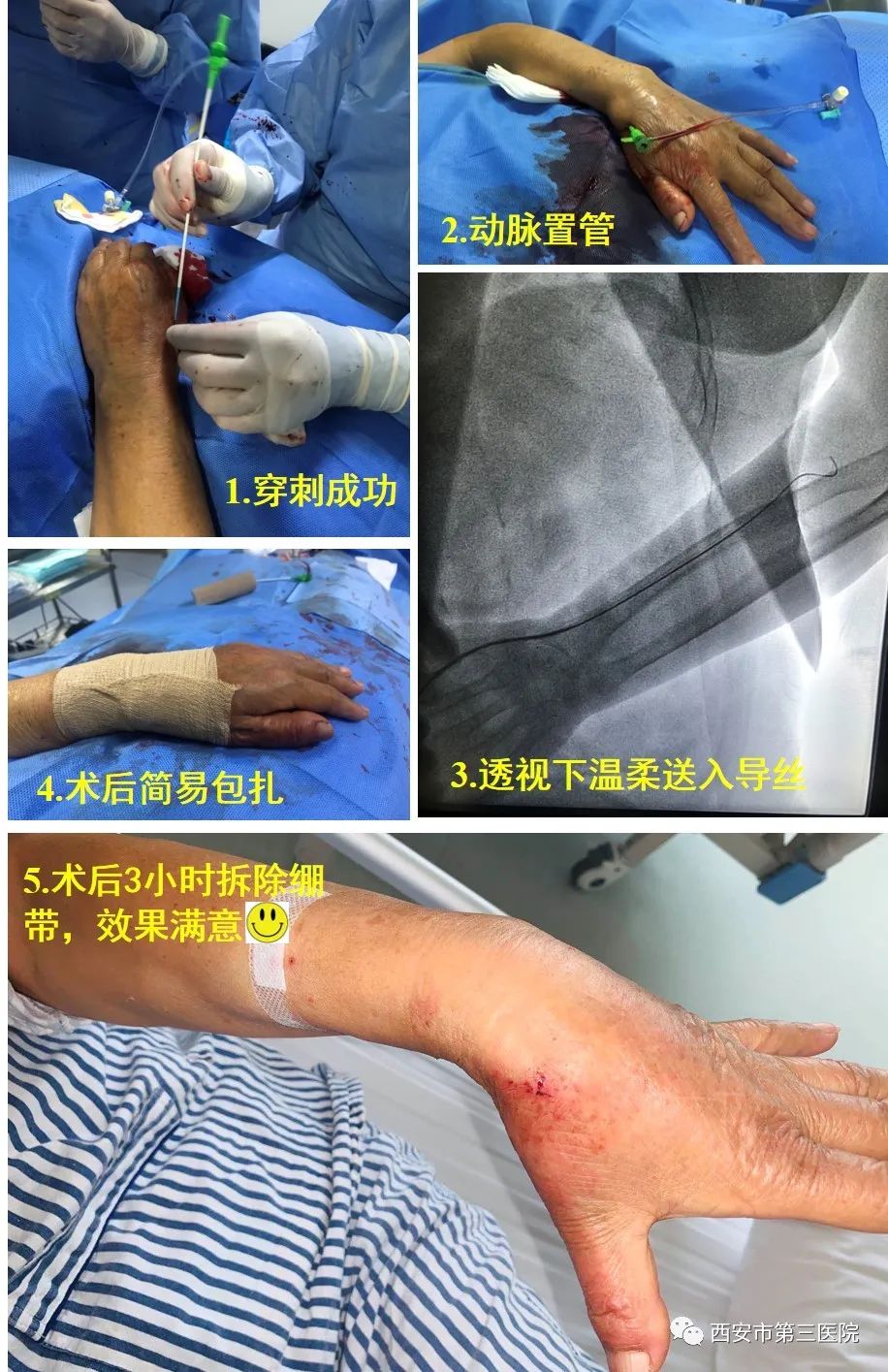 西安市第三医院经心尖tavi术六旬男子重获新生