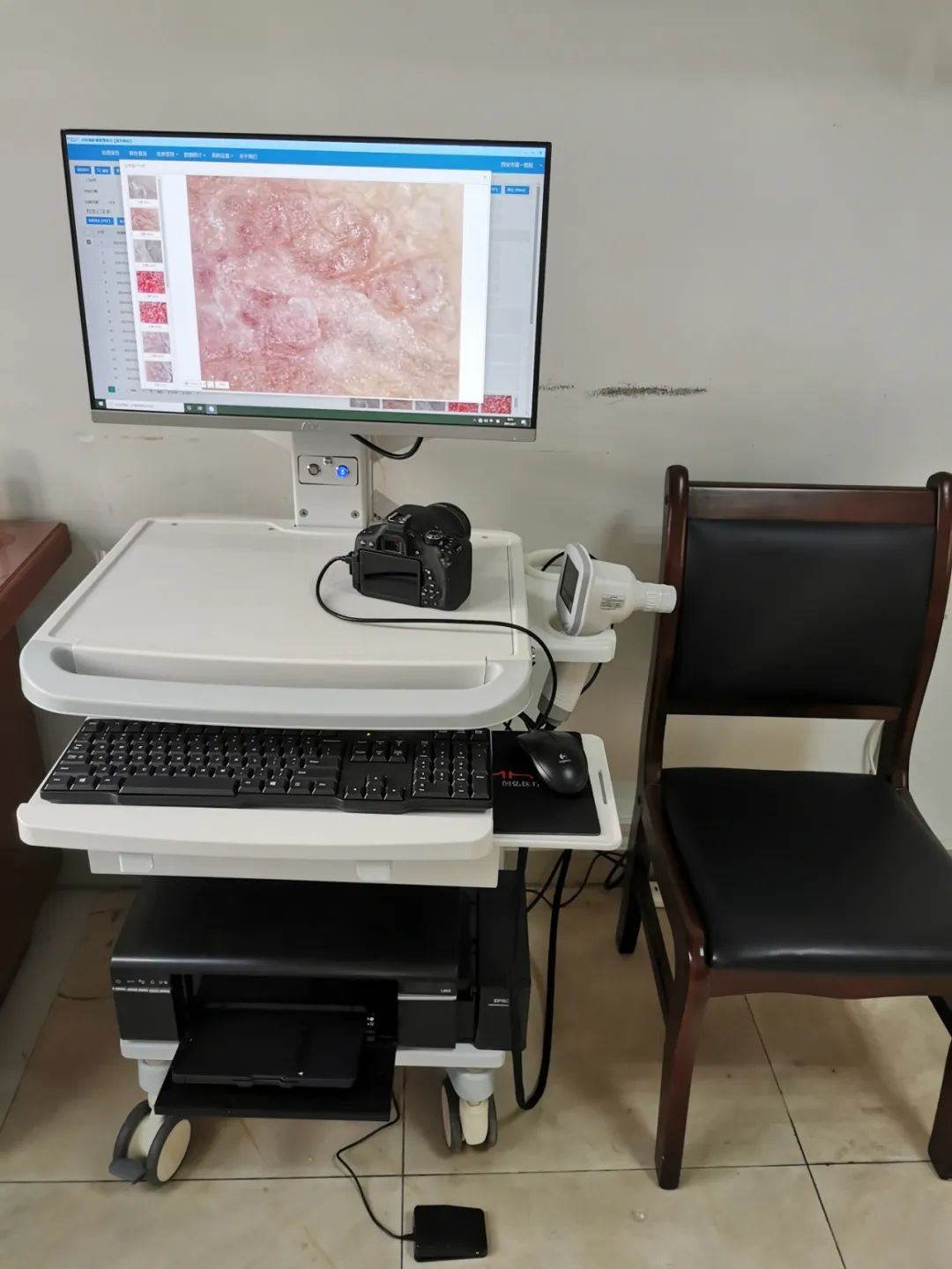 西安市第一医院良性色素痣or恶性黑素瘤皮肤镜为你提供早期诊断依据