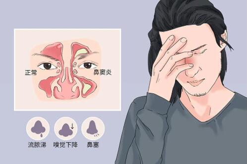 慢性鼻炎吃什么药（慢性鼻炎长期不治的后果）