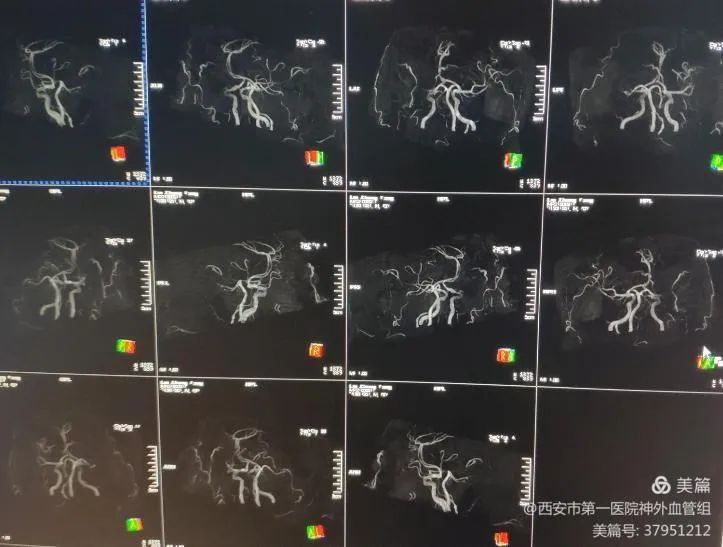西安市一院神外血管组介入病例系列9轻症脑血管闭塞