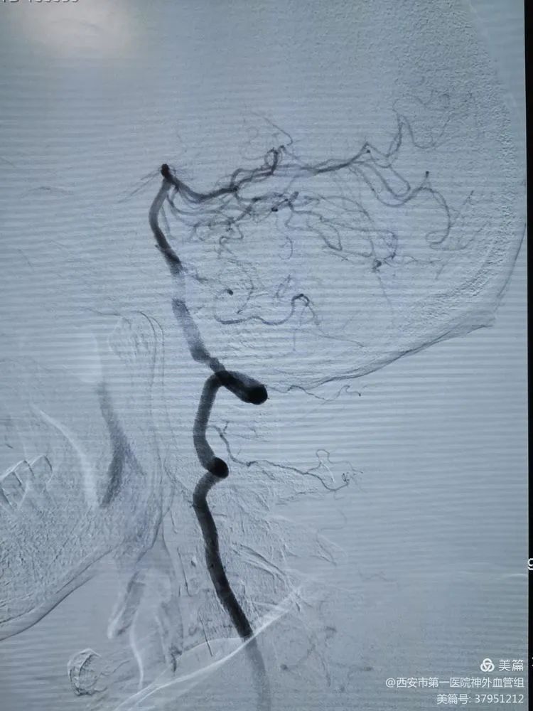 大脑后动脉有少量代偿脑血管造影提示左侧大脑中动脉m1末端闭塞,大脑