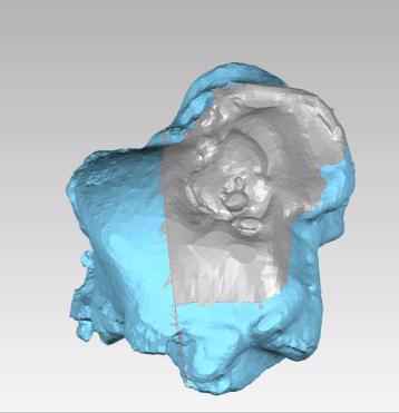 术前3D打印设计