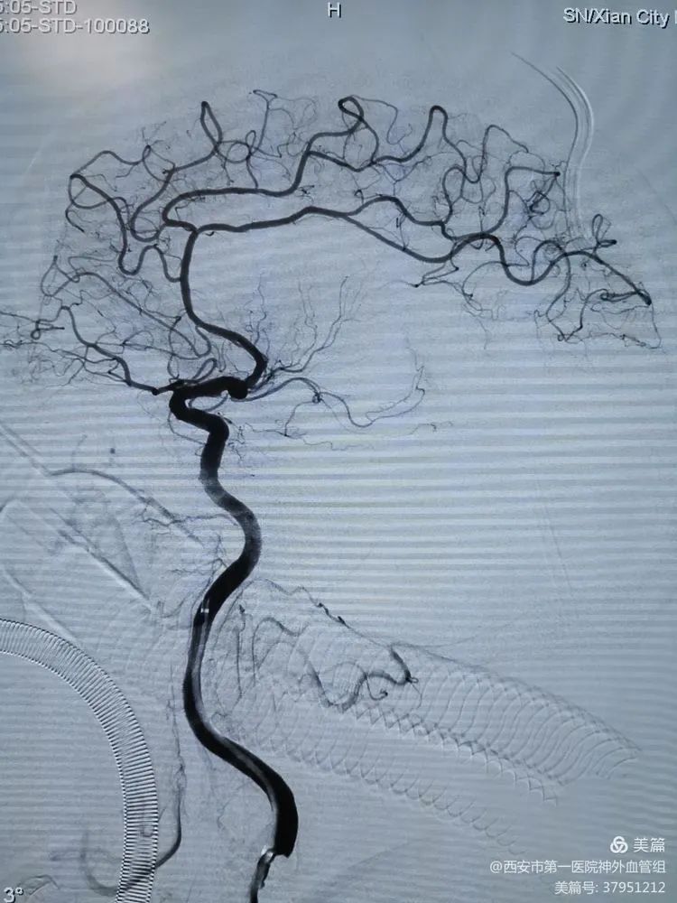 脑血管造影提示左侧大脑中动脉m1末端闭塞,大脑前有部分代偿头颅ctp