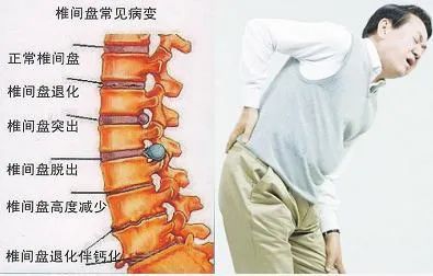腰肌劳损有哪些症状图图片