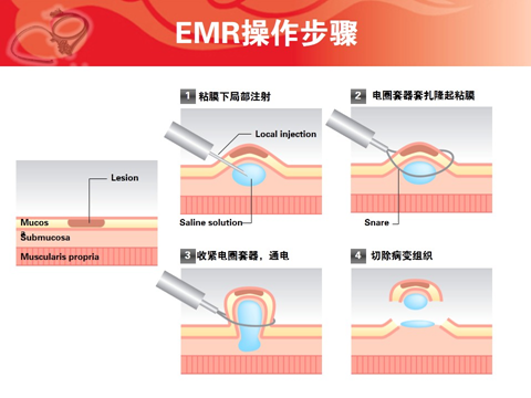 EMR手术的优势有哪些？
