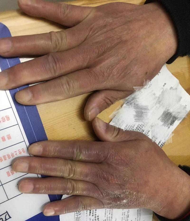 7旬偏瘫爹爹急复健服用自行采购活血化瘀药品竟致手部水肿