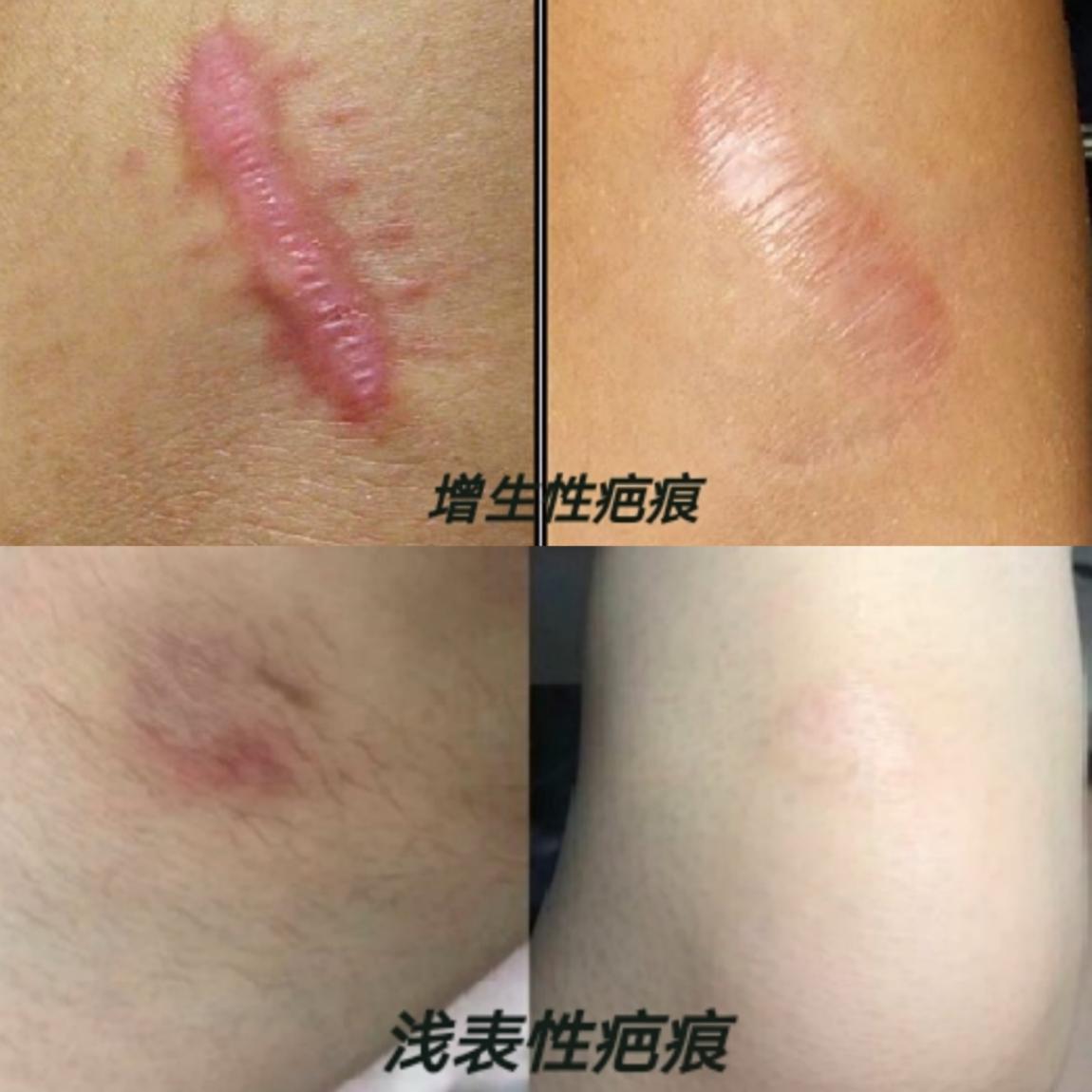 医用硅酮凝胶怎么用巴复平硅酮凝胶真能祛疤吗？揭秘网红祛疤膏效果_https://www.jmylbn.com_新闻资讯_第3张