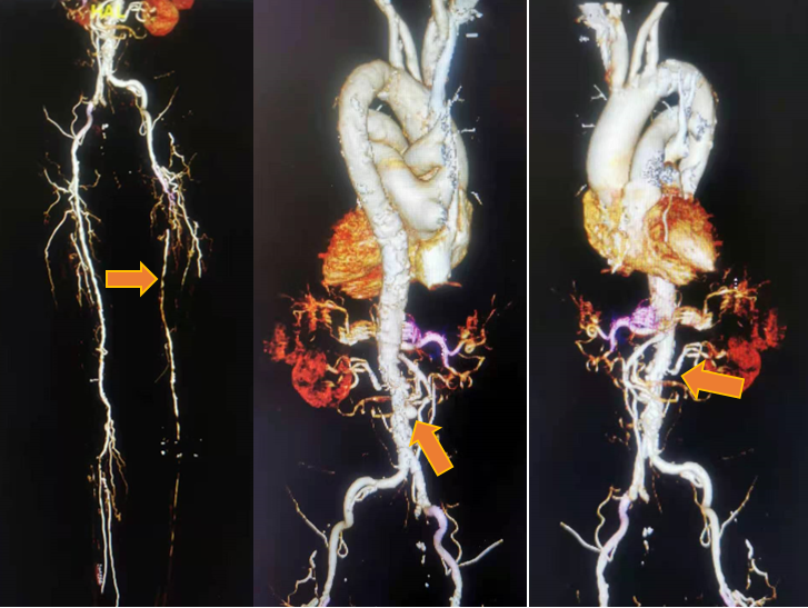 合肥京东方医院心脏大血管外科在外周血管介入治疗为患者解决病痛