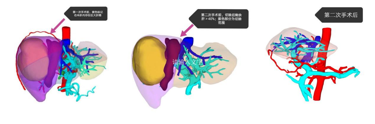 深大总医院引进全球领先肝癌人工智能AI临床决策系统造福患者