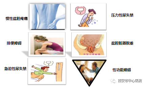西安市中心医院:女性产后盆底肌为什么需要锻炼