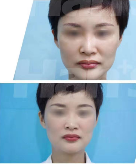 济南水光针皮肤美容整形医院哪家好?