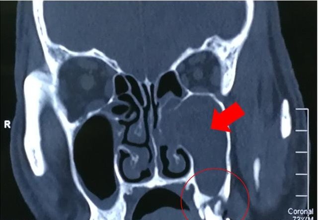 成都哪里治牙源性上颌窦炎好成都民生耳鼻喉医院怎么样