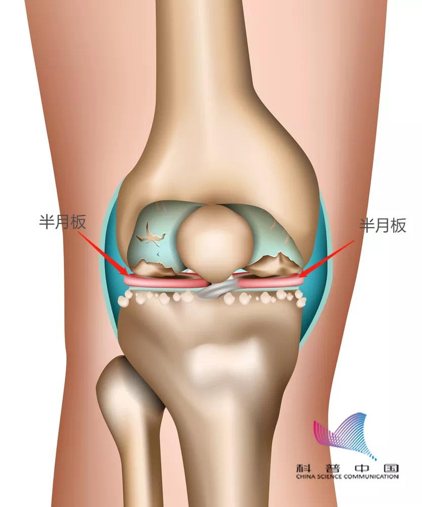 半月板是位于大腿的股骨和小腿的胫骨之间的纤维软骨,每侧膝关节各自