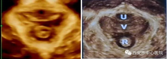 西安市中心医院:女性产后盆底肌为什么需要锻炼