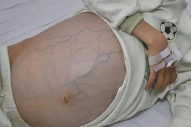 西安市中医医院：消臌散敷脐治疗肝硬化腹水疗效佳