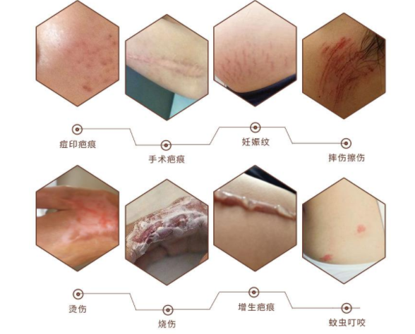 成都疤痕如何治疗成都军建医院专业祛疤机构四步骤完美祛疤