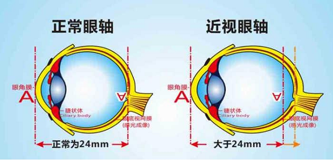 武汉普瑞眼科医院林珊防控近视要科学4大误区需谨防