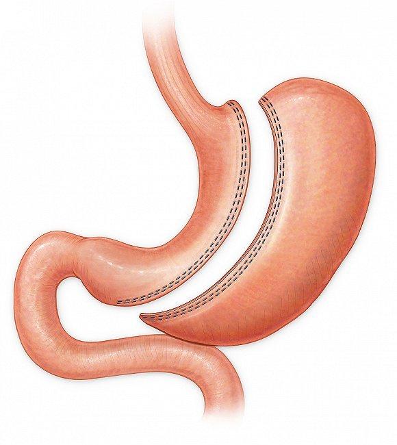 袖状胃手术全称腹腔镜缩胃手术,手术方法是顺着胃大弯的走行方向保留2