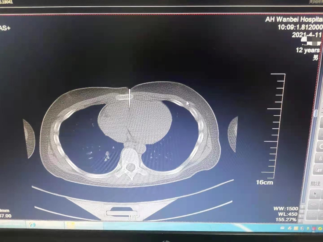 安徽一男童误将气钉枪当玩具 钉子穿透胸骨直达心脏 凤凰网安徽_凤凰