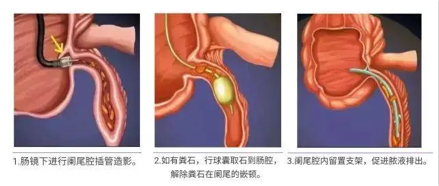 赣南医学院第一附属医院消化内科开展内镜逆行阑尾炎治疗术