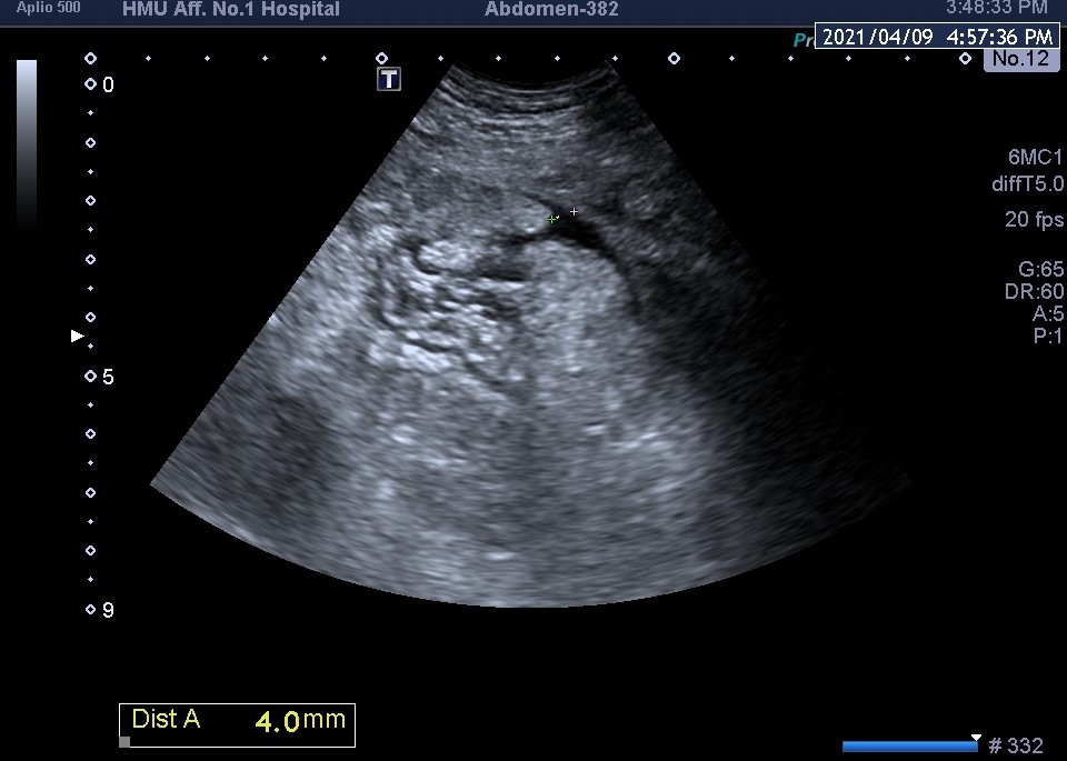 患者胆囊穿孔伴胆囊周围包裹性积液,此时患者已出现明显腹膜炎症状,经