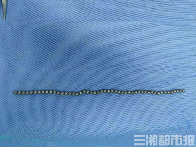 男童尿道膀胱内取出68颗磁力珠留意青春期孩子的 小动作 凤凰网