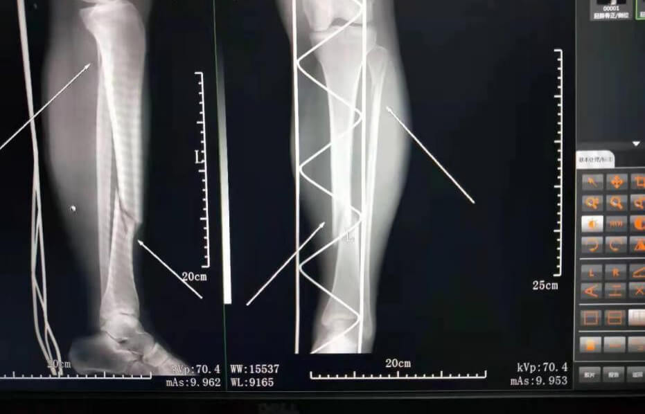 粉碎性骨折患者抗拒手術治療感激鄧氏骨科成功治癒骨傷