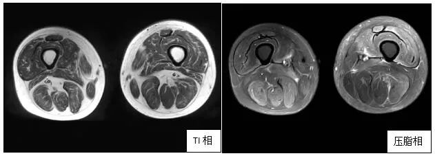 肌肉磁共振（2021年1月14日）显示患者双大腿肌肉较前明显恢复