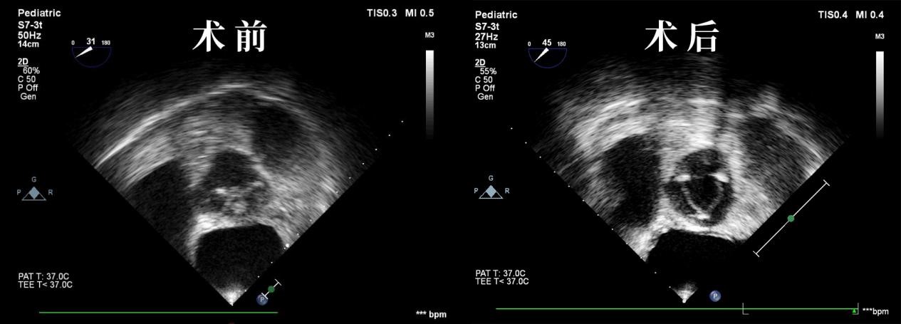 干瓣很牛亚心总医院成功完成华中地区首例主动脉瓣干瓣植入术