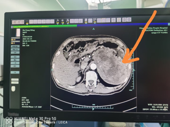 胃癌图片 报告单图片