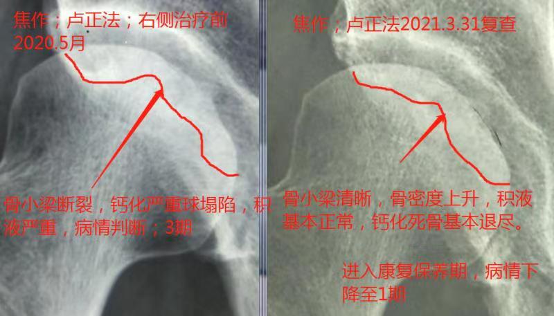 六月寒中医“蒸敷灸”治疗“股骨头坏死”