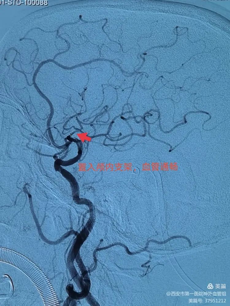 西安市第一醫院神外血管組介入病例介紹複雜大腦中動脈閉塞開通