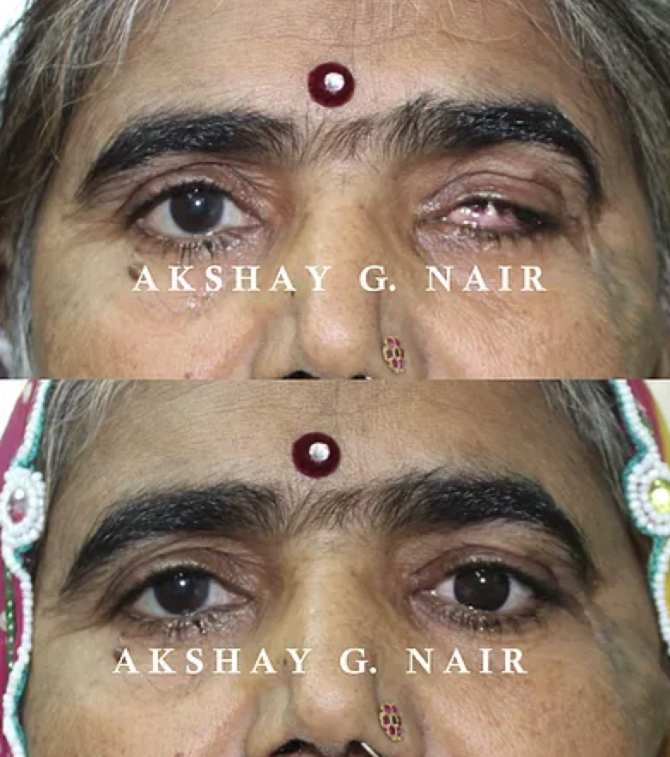 印度又一致命疾病大爆发!