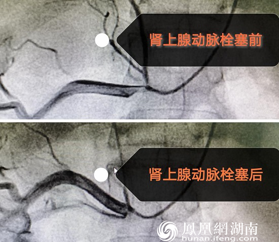 湖南首例！常德一医成功开展经导管肾上腺动脉无水酒精栓塞术