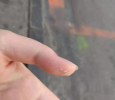 每天开启300余个疫苗瓶盖手指被磨得秃噜皮了